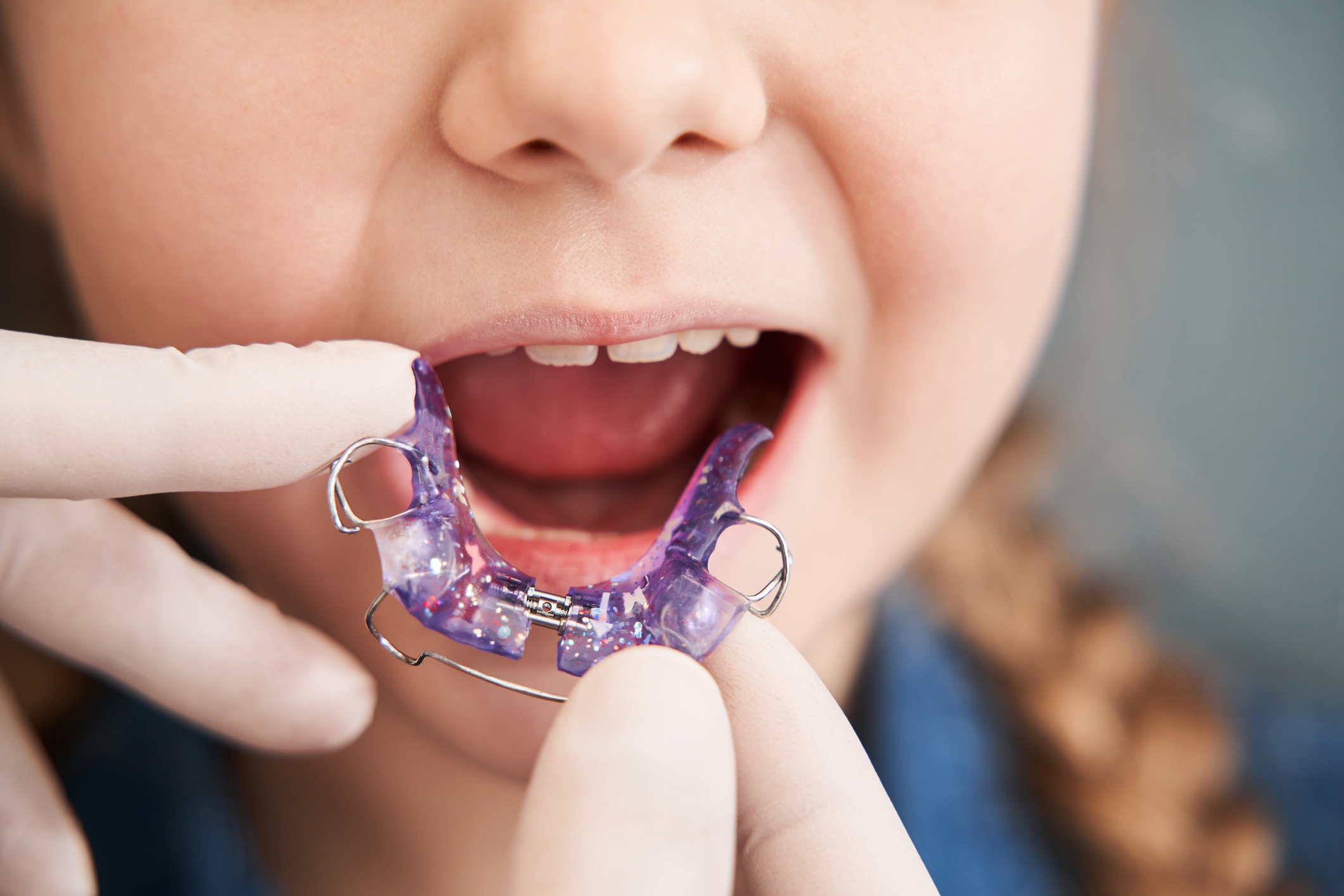 Ortodoncia interceptiva: corrigiendo problemas dentales a tiempo