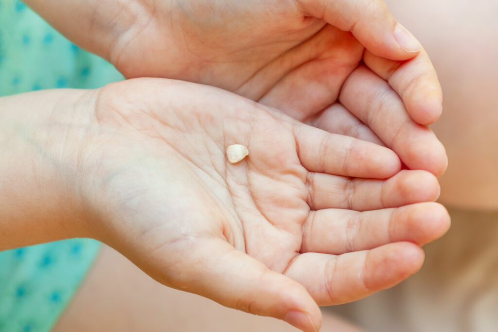 dientes de leche con caries