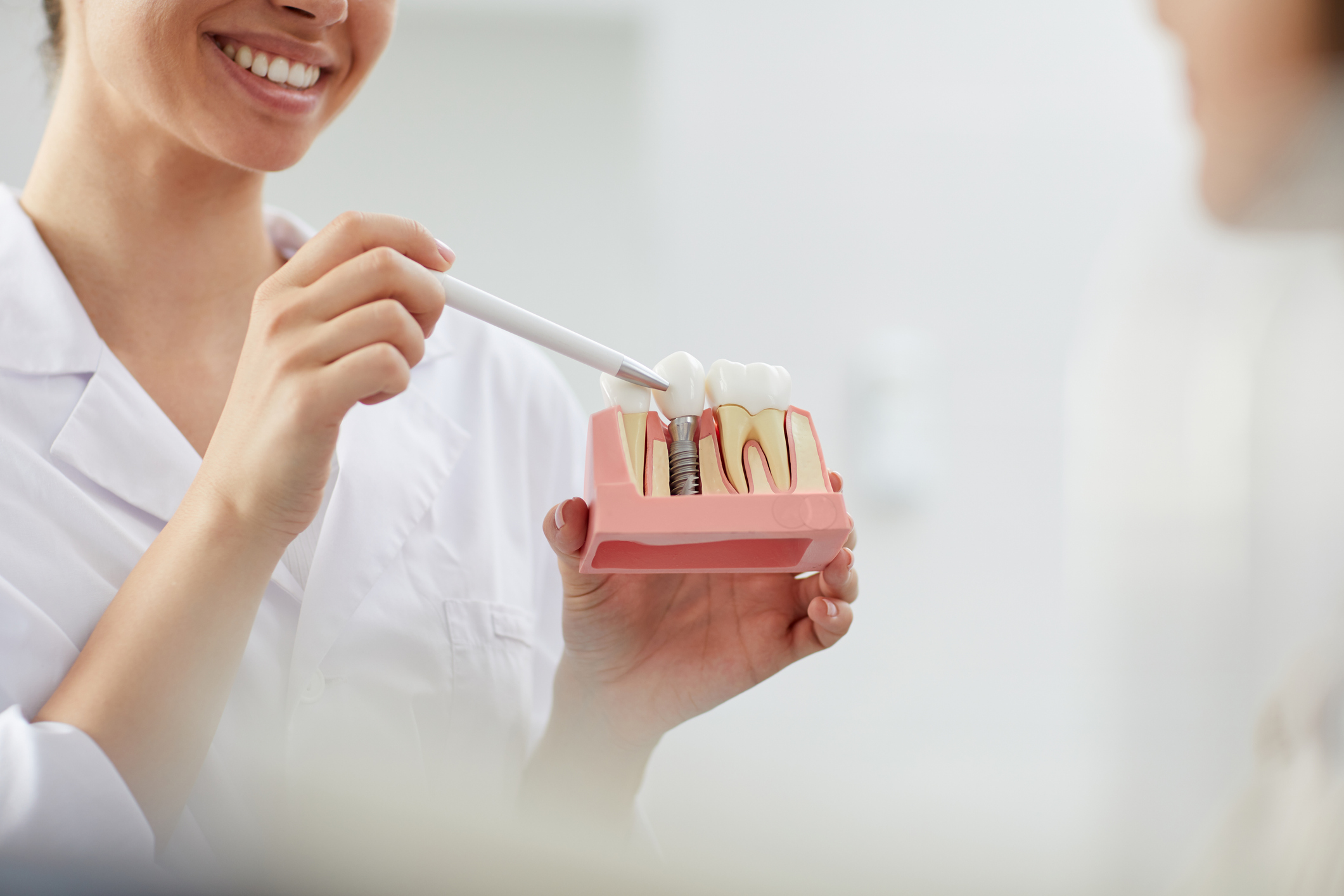 Implantes dentales: qué hábitos pueden afectar su integración a largo plazo