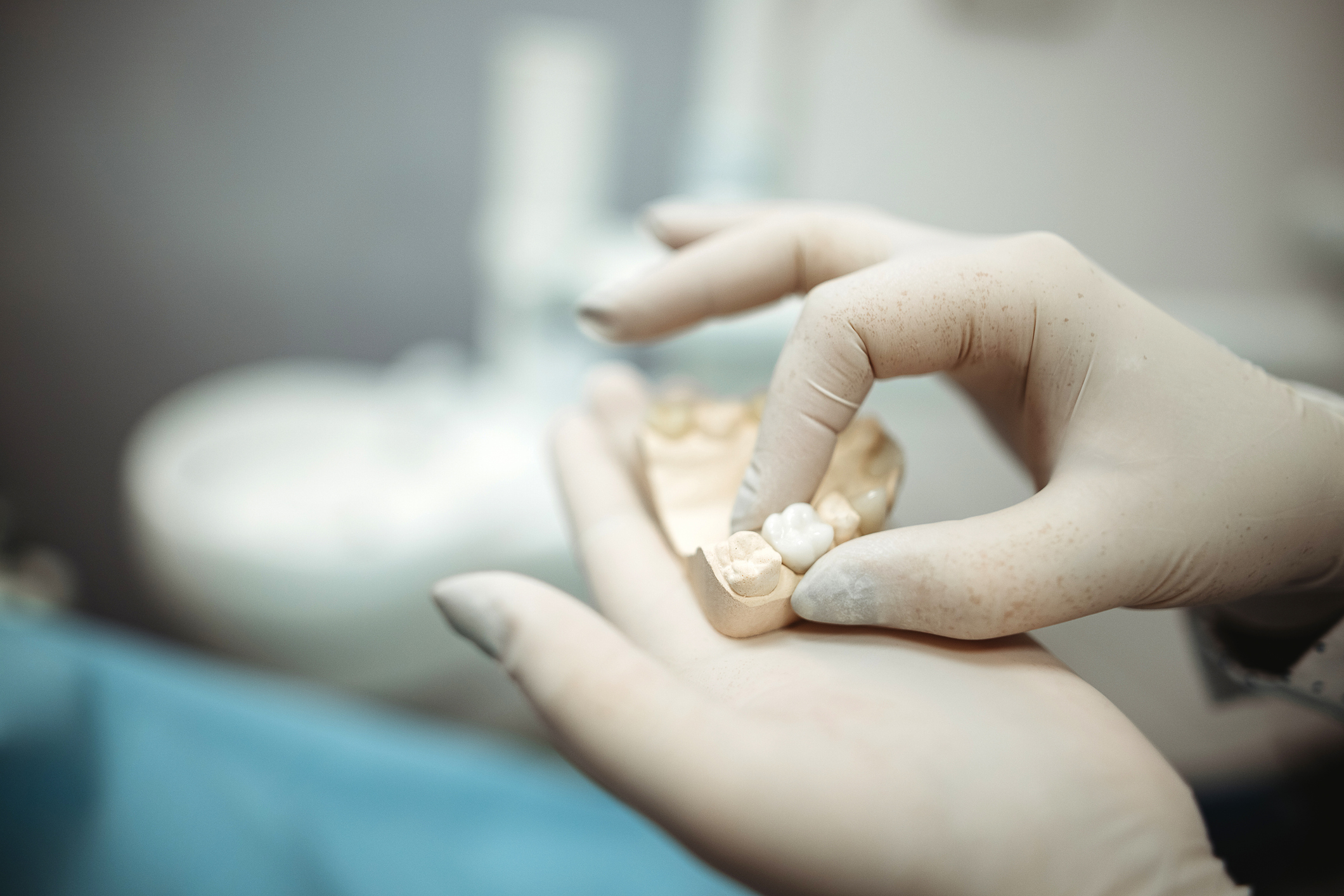 Cuándo es recomendable colocar una corona dental